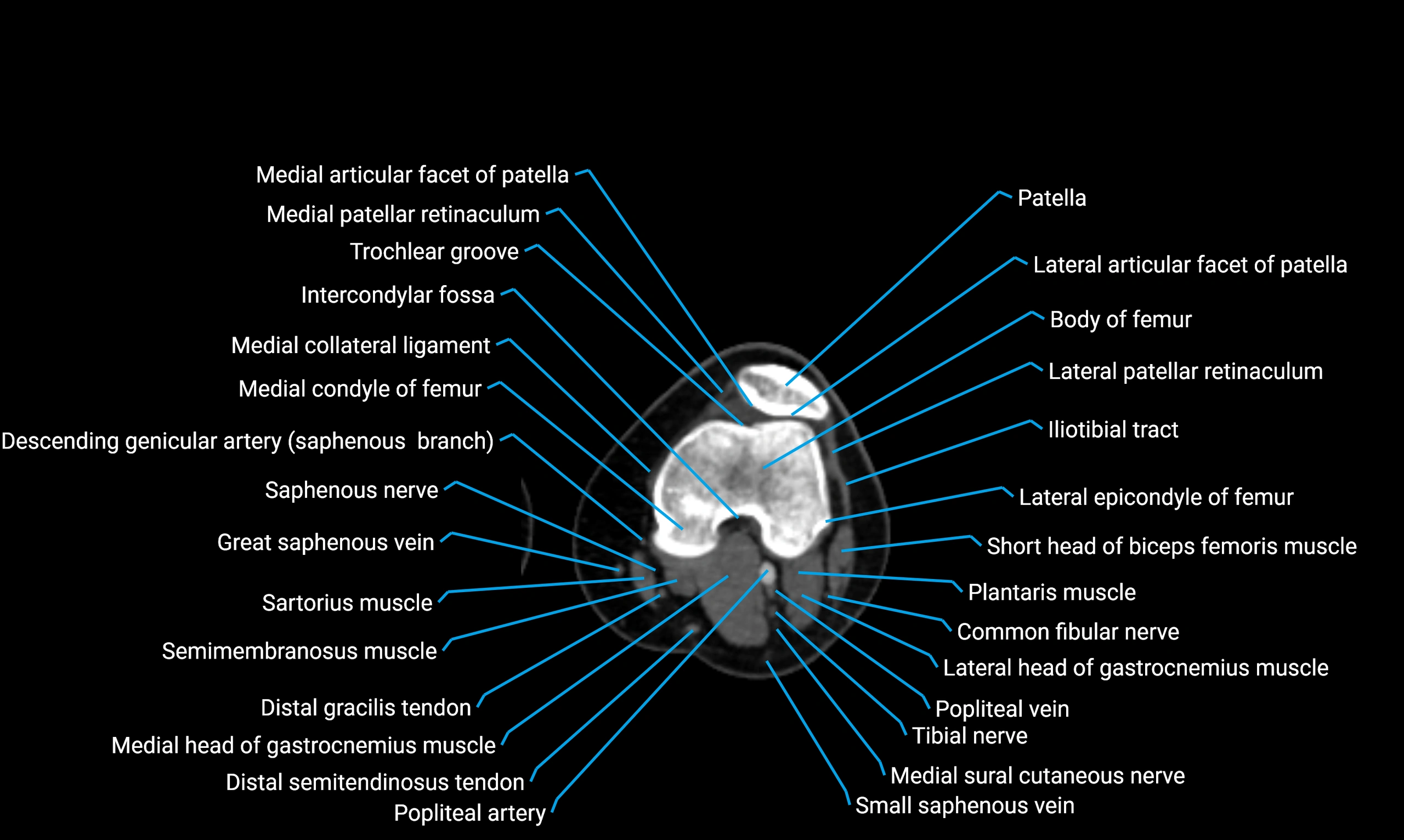 CT thigh axial cross sectional anatomy labelled image_84 (2).webp